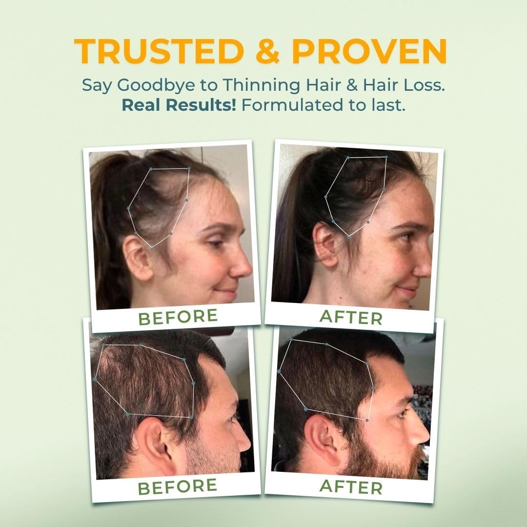 Vital Hair Complex Supplement – Biotin & B Vitamins for Hair, Skin & Nails