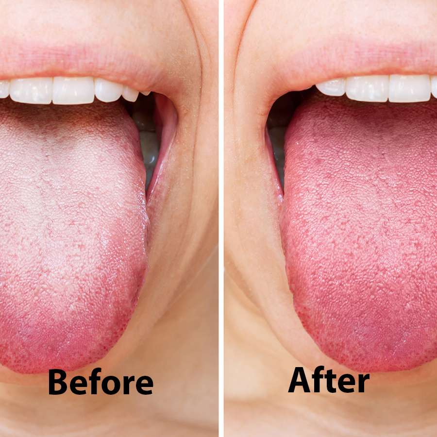Stainless Steel Tongue Scraper